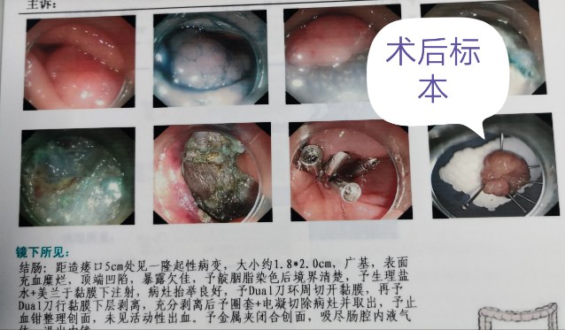 直肠癌四期患者生存奇迹,19年的坚韧与希望之路,直肠癌四期患者的生命奇迹,19年坚韧之路,希望永不止步