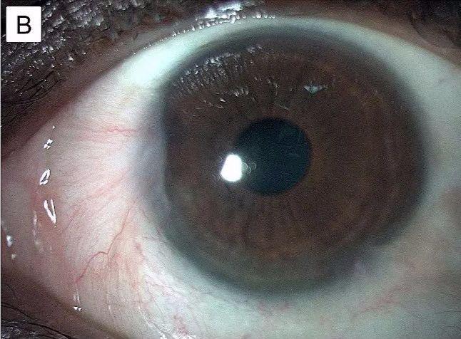 胬肉,一种常见的眼部疾病及其治疗,眼部疾病胬肉的治疗与应对