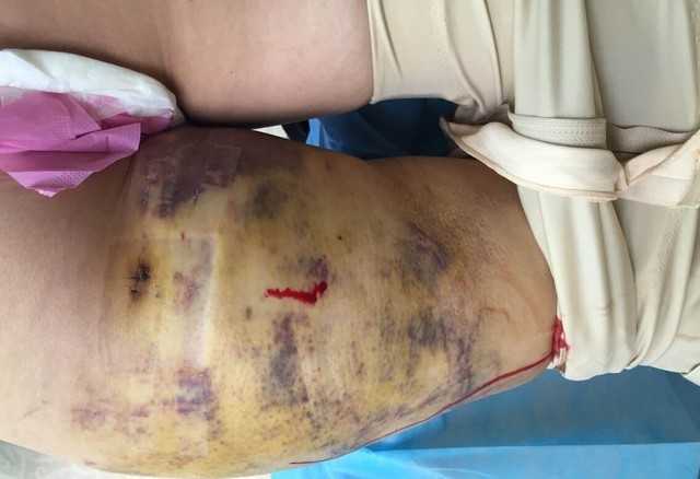 抽脂手术后的痛苦经历,抽脂手术后的艰辛历程