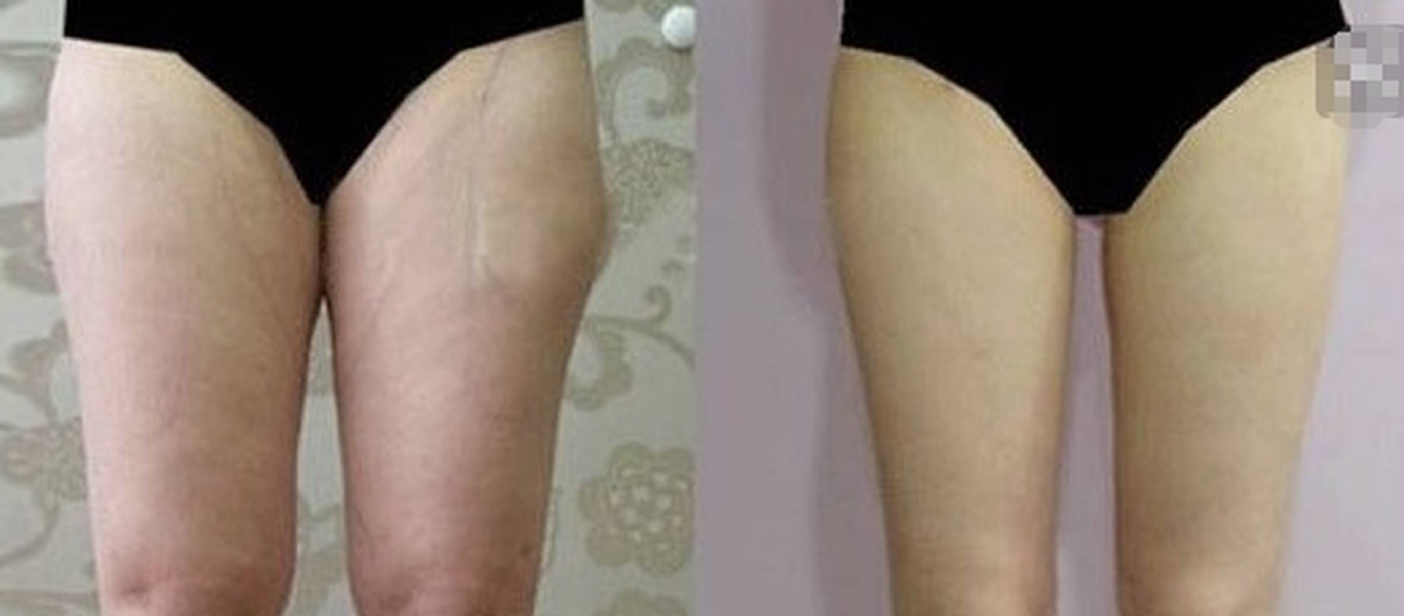 抽脂手术后的痛苦经历,抽脂手术后的艰辛历程