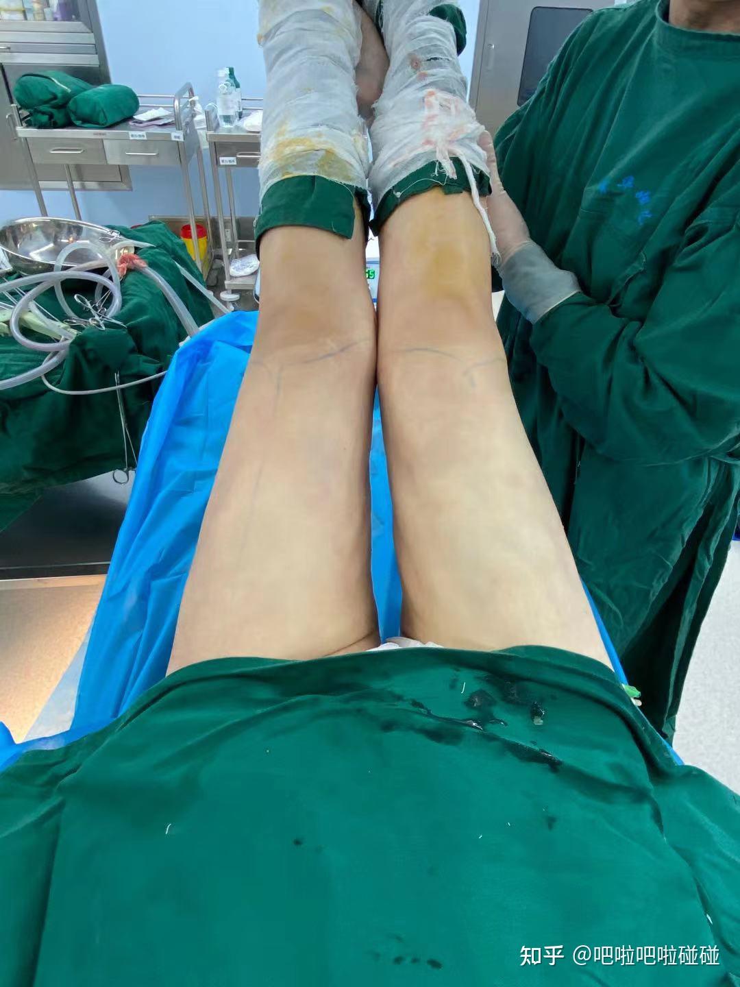 抽脂手术后的痛苦经历,抽脂手术后的艰辛历程